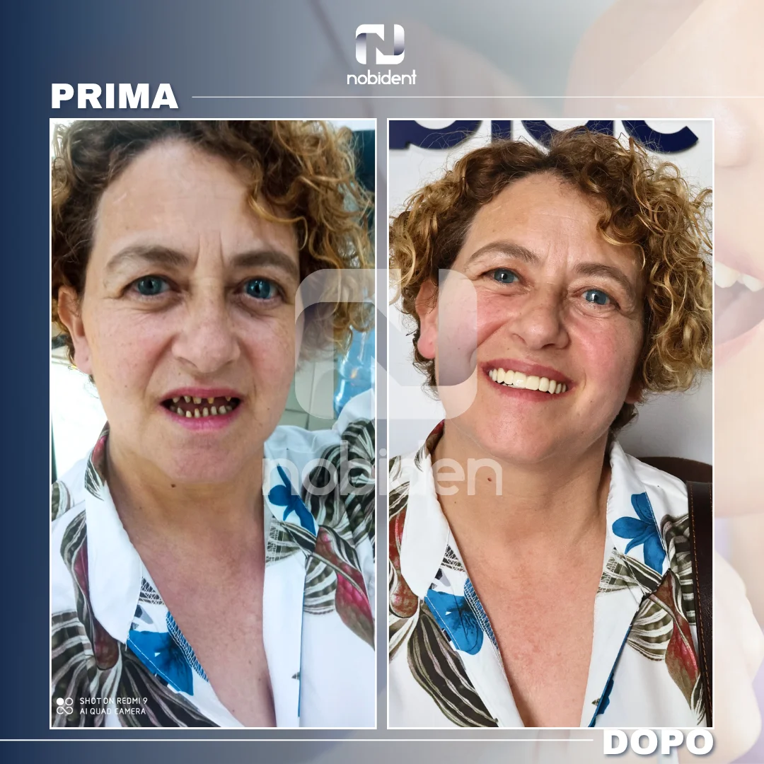 Caso NobiDent, prima e dopo della paziente