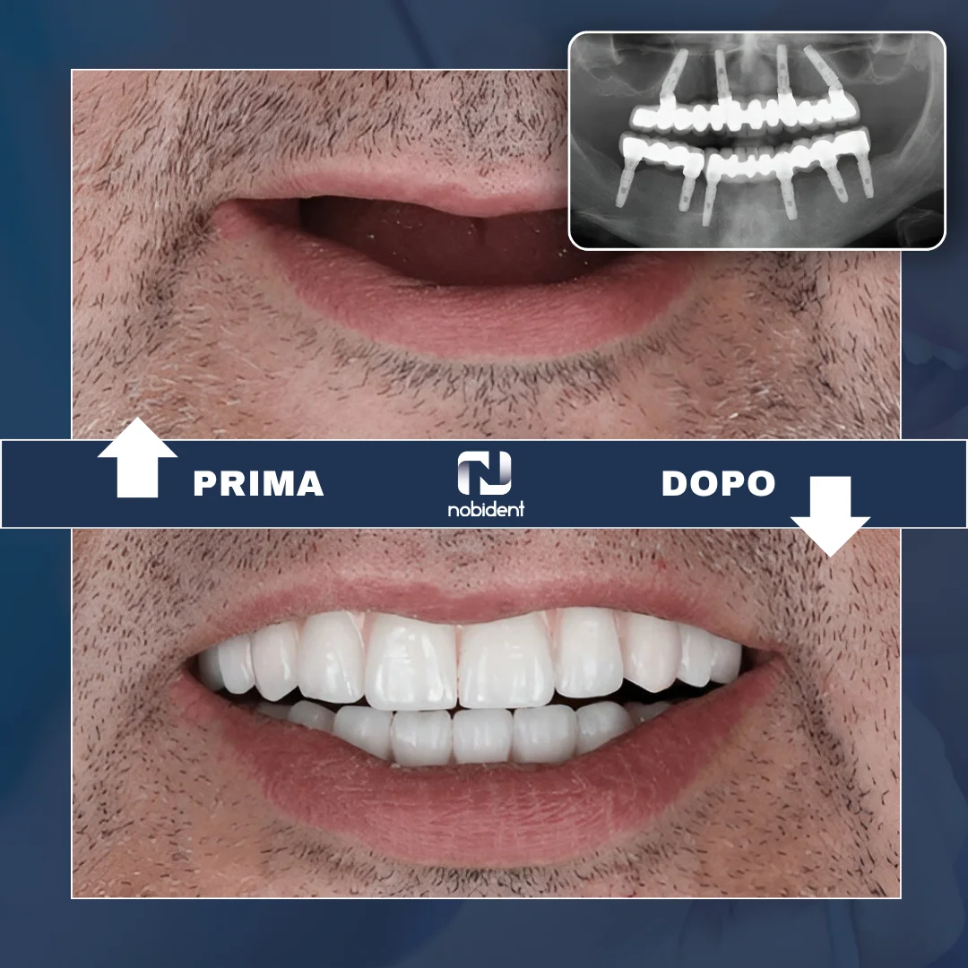 Paziente NobiDent, trattamento completo documentato con radiografia