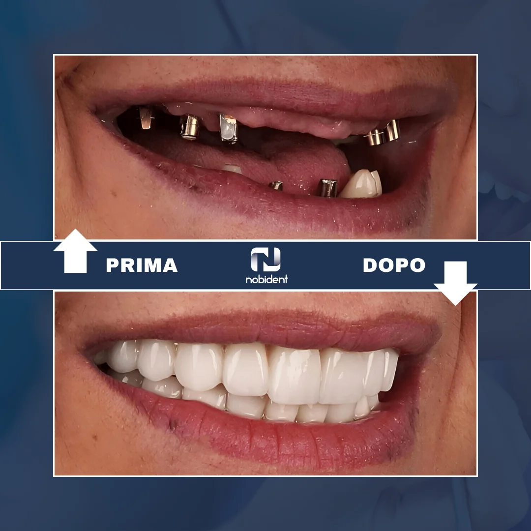 Caso NobiDent, prima e dopo di riabilitazione dentale