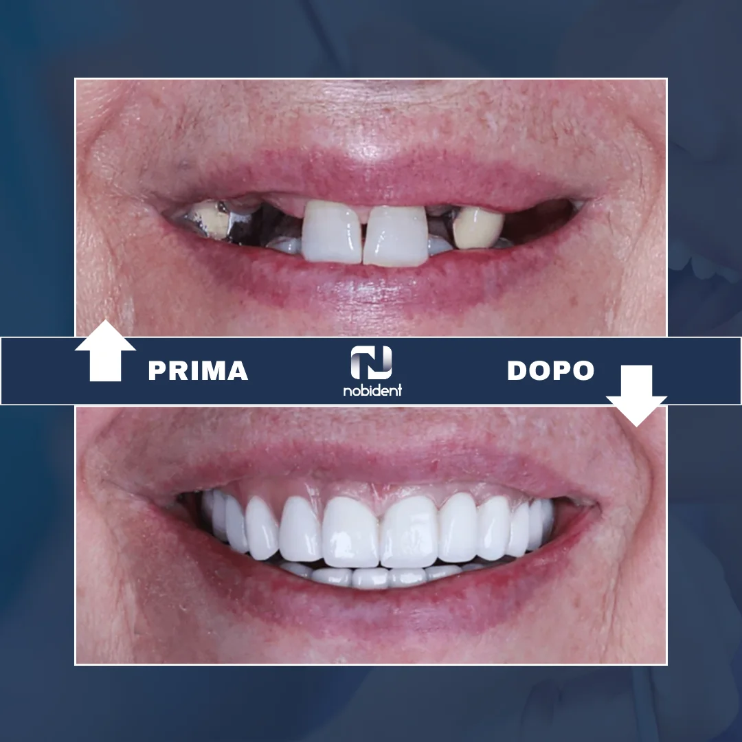 Caso NobiDent, trasformazione dentale prima e dopo