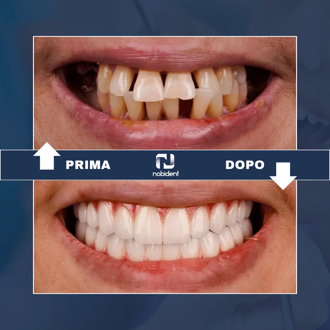 Caso NobiDent, confronto prima e dopo dei denti